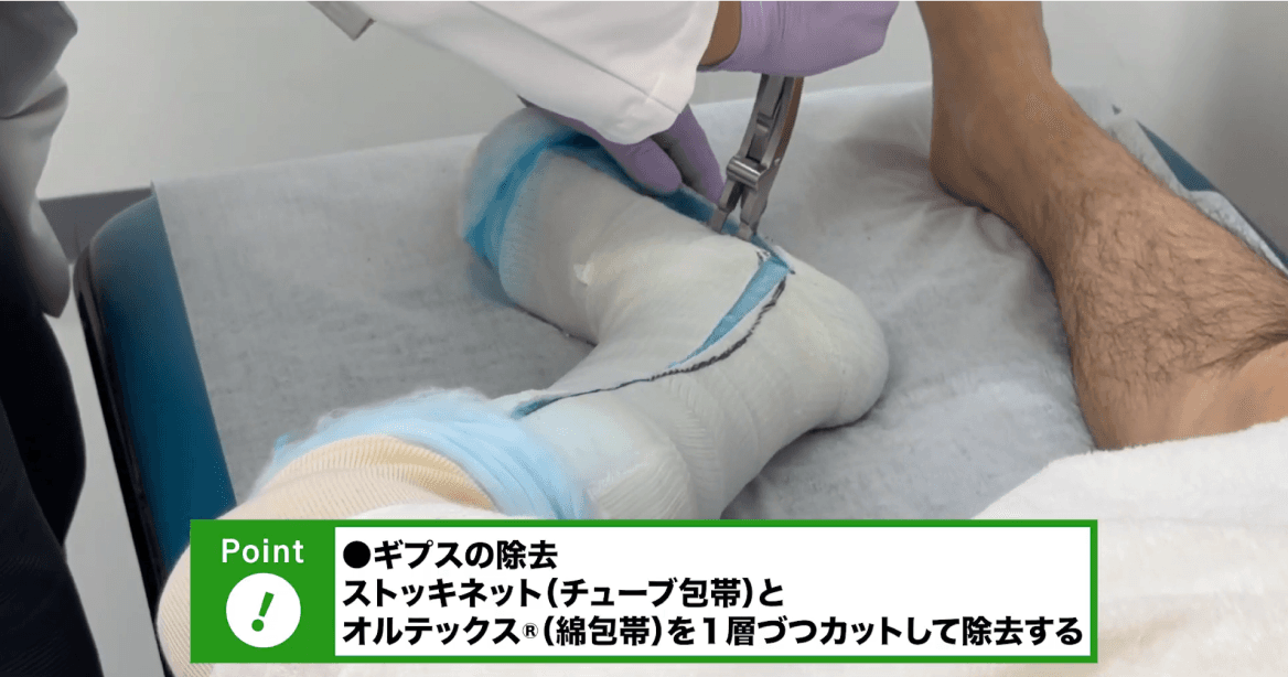 下腿キャストカット